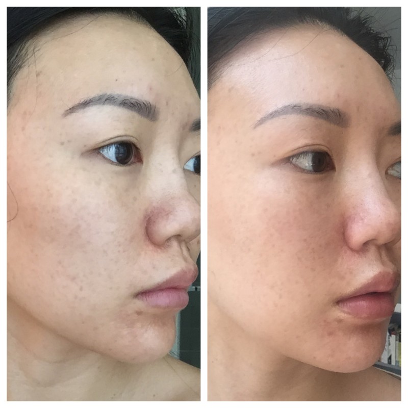 soin de visage  carbon Peel quels sont les bienfaits et quand doit-on le faire ?