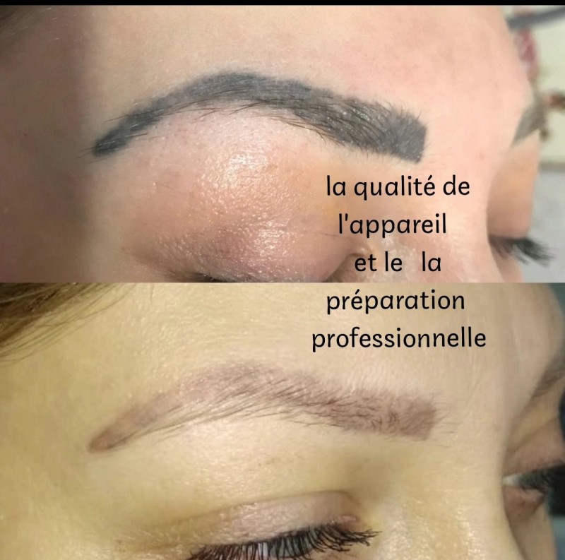 Comment se débarrasser d'un tatouage de sourcils ou de lèvres ?