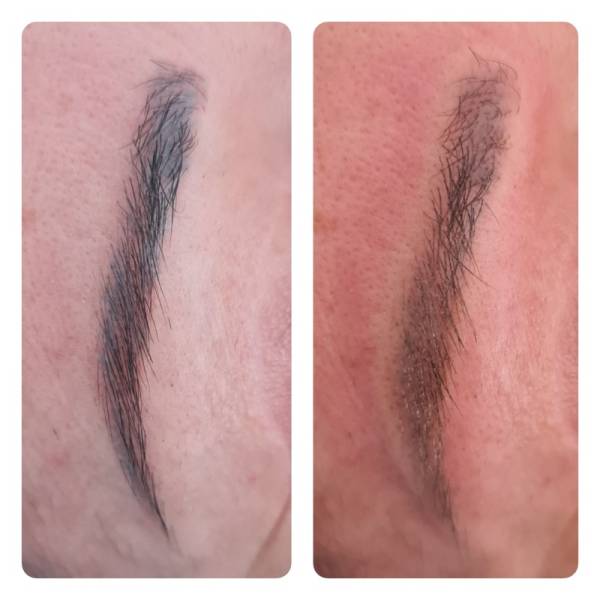 détatouage sourcil aix en provence