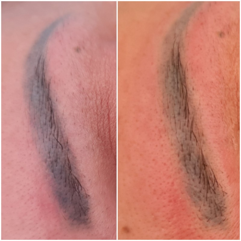 détatouage sourcils laser cicatrisation Aix-en-Provence