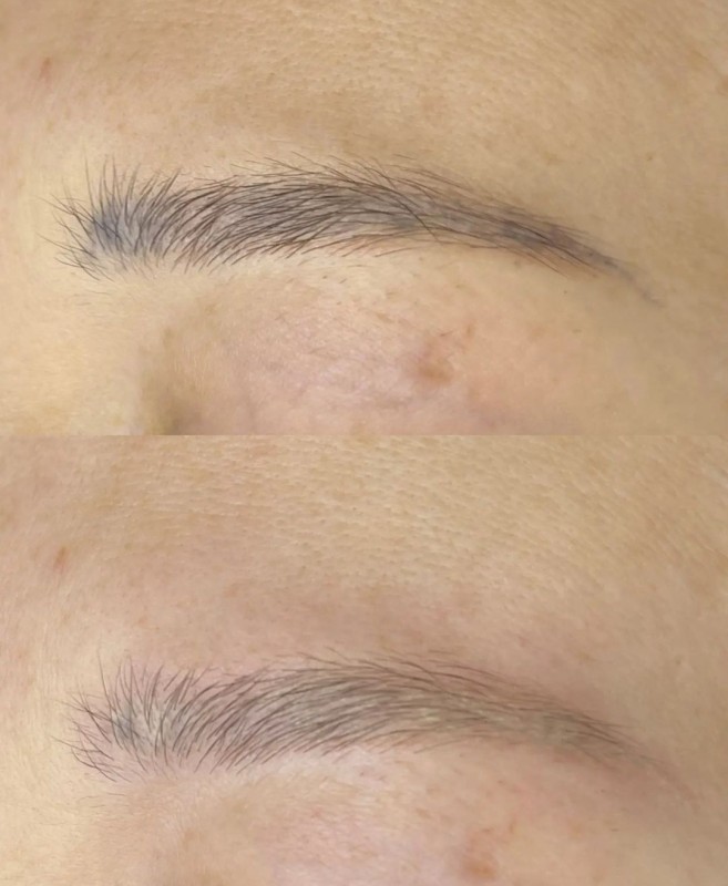 Le détatouage laser à La Ciotat : effacez vos anciens tatouages sans douleur