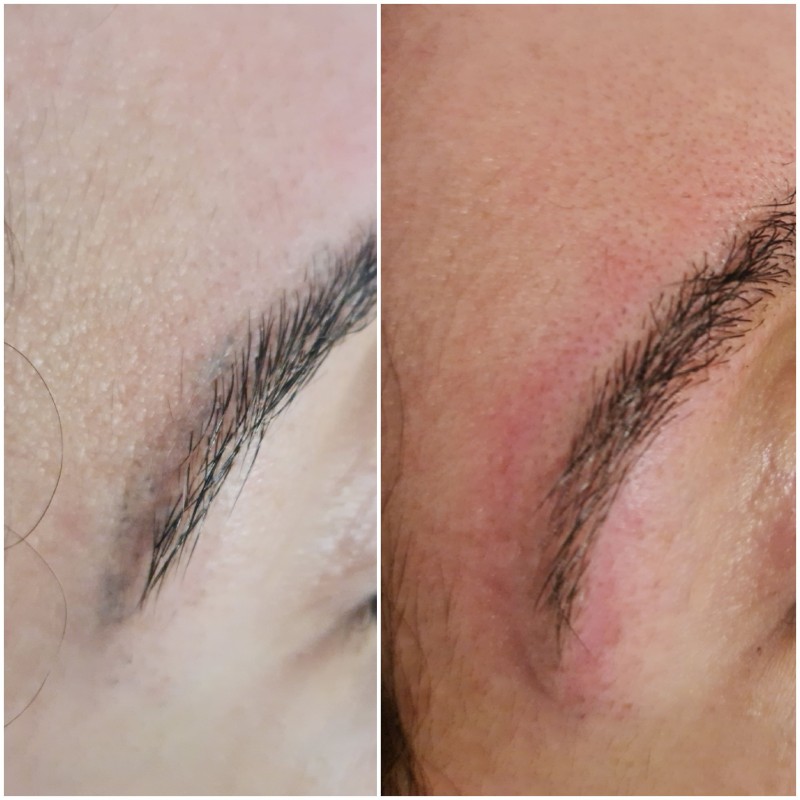 retirer le tatouage Des sourcils efficacement et rapidement Marseille La Ciotat