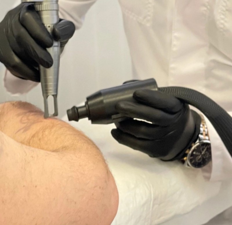 Centre de détatouage : faites disparaitre votre dermopigmentation taches de rousseur à La Ciotat