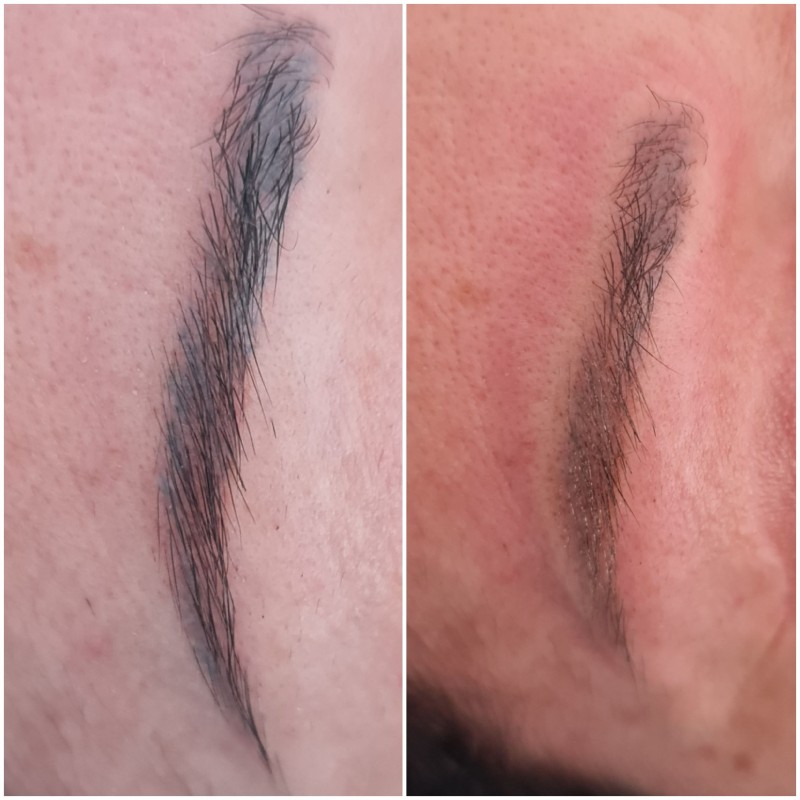 détatouage sourcils laser cicatrisation Aix-en-Provence