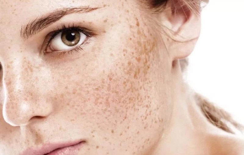 Taches de rousseur : enlevez-les avec notre technique de détatouage à La Ciotat