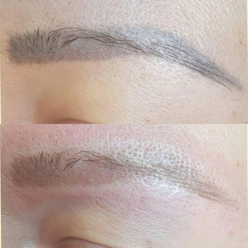 Centre de détatouage : faites disparaitre votre dermopigmentation taches de rousseur à La Ciotat