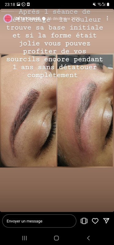 Avant/Apres détatouage chez Black Line Studio – Adieu le contour gris !