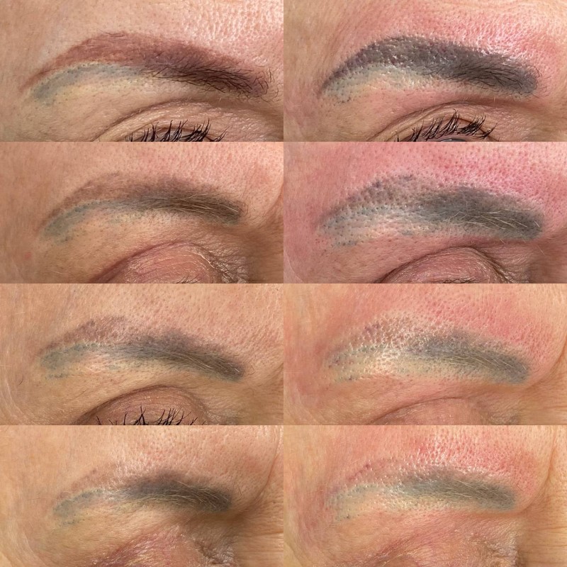 retirer le tatouage Des sourcils efficacement et rapidement Marseille La Ciotat