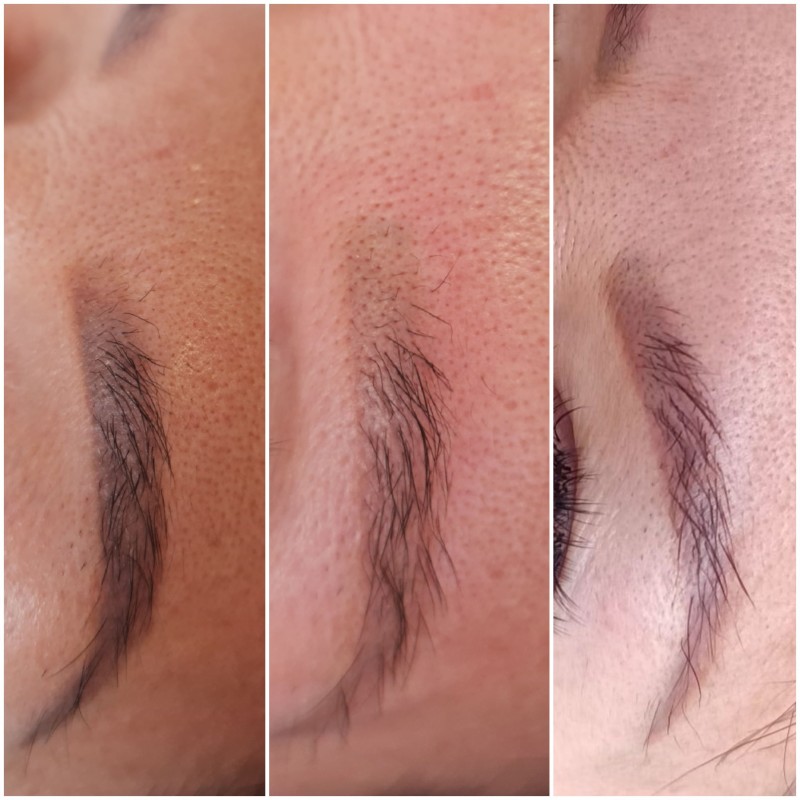 retirer le tatouage Des sourcils efficacement et rapidement Marseille La Ciotat