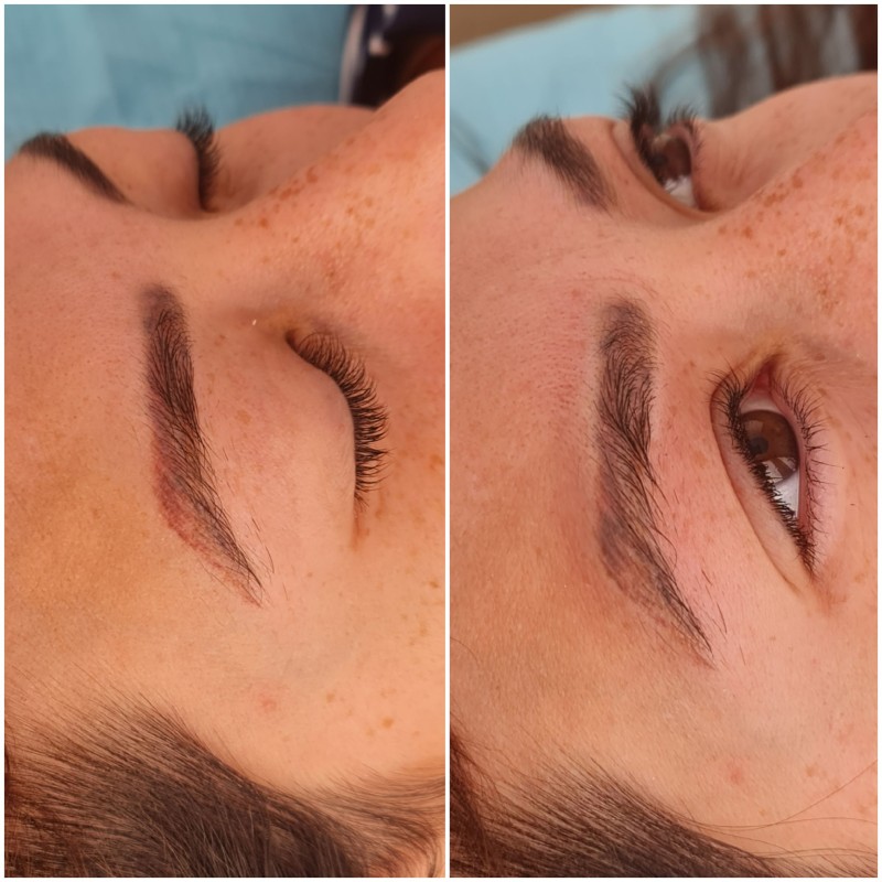 détatouage sourcils laser cicatrisation Aix-en-Provence