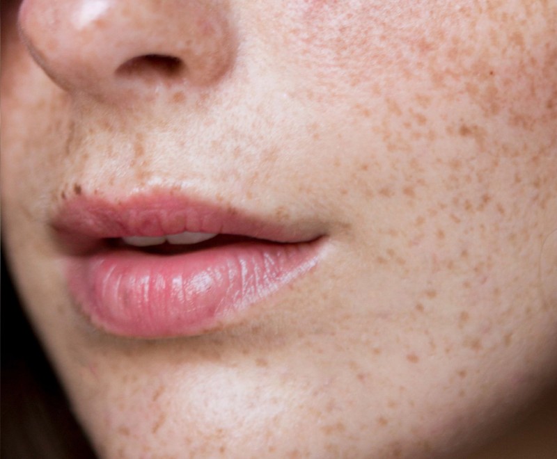 Taches de rousseur : enlevez-les avec notre technique de détatouage à La Ciotat