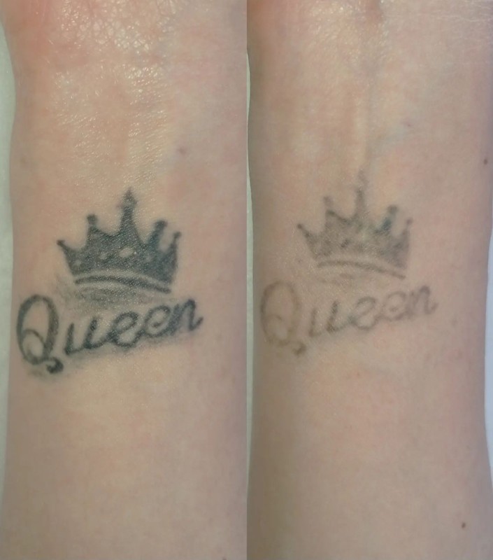 Le détatouage laser à La Ciotat : effacez vos anciens tatouages sans douleur